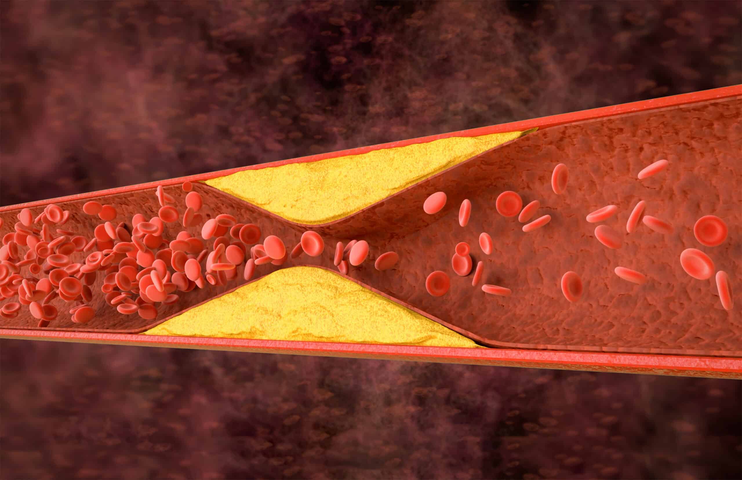 Cross-section of a blood vessel with yellowish plaque buildup narrowing the passage, limiting red blood cell flow and showing atherosclerosis.