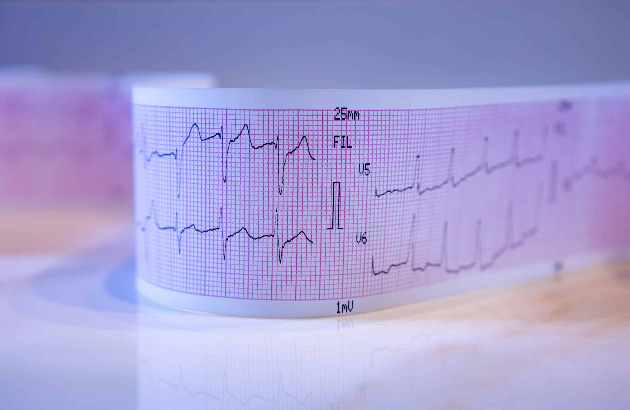 Close-up of a printed electrocardiogram strip displaying heart activity on pink graph paper with black waveforms and labeled leads.
